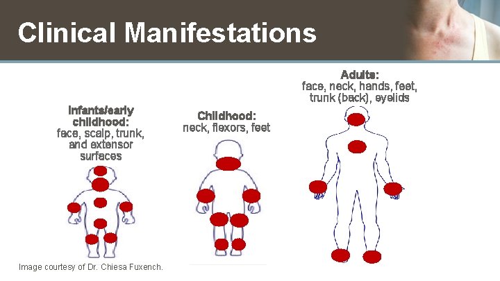 Clinical Manifestations Adults: face, neck, hands, feet, trunk (back), eyelids Infants/early childhood: face, scalp,