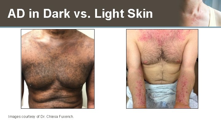 AD in Dark vs. Light Skin Images courtesy of Dr. Chiesa Fuxench. 