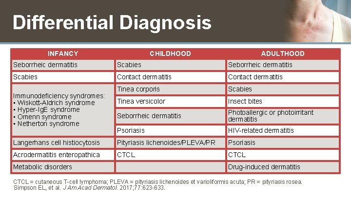 Differential Diagnosis INFANCY CHILDHOOD ADULTHOOD Seborrheic dermatitis Scabies Contact dermatitis Tinea corporis Scabies Tinea