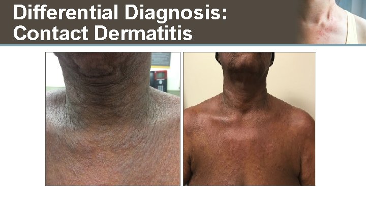 Differential Diagnosis: Contact Dermatitis 