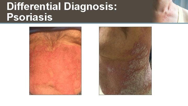 Differential Diagnosis: Psoriasis 