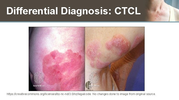 Differential Diagnosis: CTCL https: //creativecommons. org/licenses/by-nc-nd/3. 0/nz/legalcode. No changes done to image from original