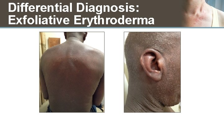 Differential Diagnosis: Exfoliative Erythroderma 