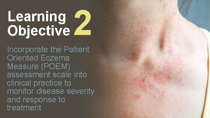 Learning Objective 2 Incorporate the Patient Oriented Eczema Measure (POEM) assessment scale into clinical