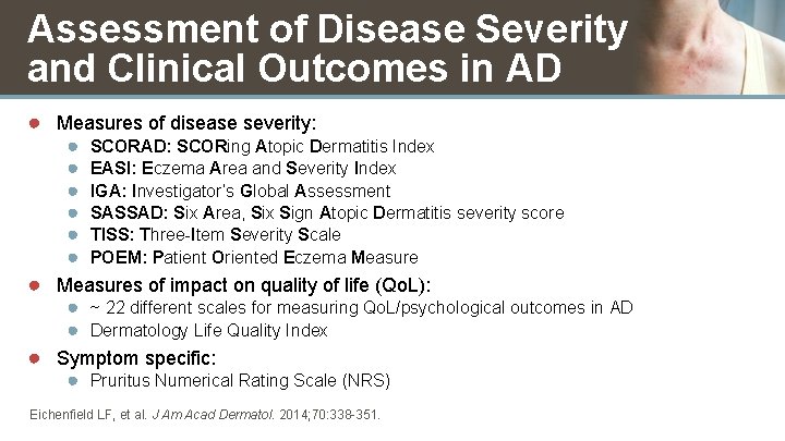 Assessment of Disease Severity and Clinical Outcomes in AD ● Measures of disease severity: