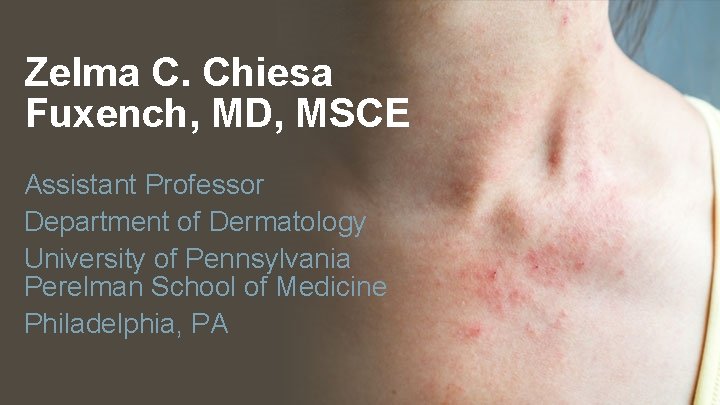 Zelma C. Chiesa Fuxench, MD, MSCE Assistant Professor Department of Dermatology University of Pennsylvania
