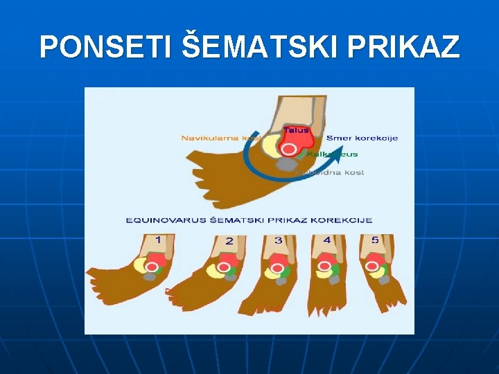 PONSETI ŠEMATSKI PRIKAZ 