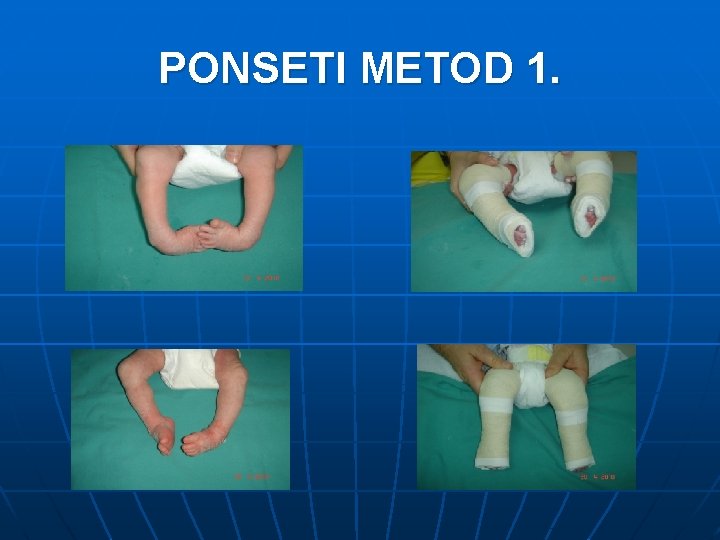 PONSETI METOD 1. 