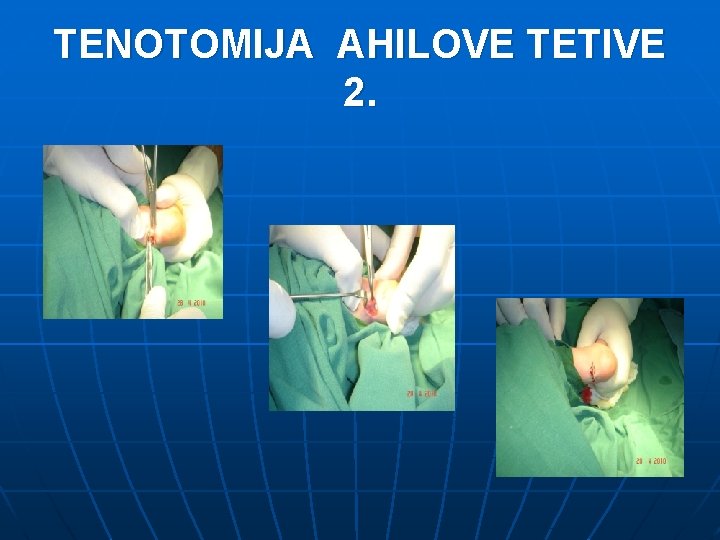 TENOTOMIJA AHILOVE TETIVE 2. 