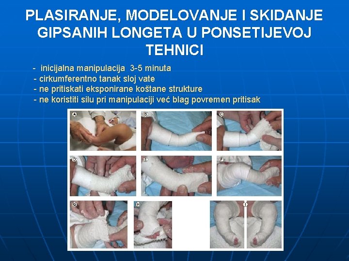 PLASIRANJE, MODELOVANJE I SKIDANJE GIPSANIH LONGETA U PONSETIJEVOJ TEHNICI - inicijalna manipulacija 3 -5