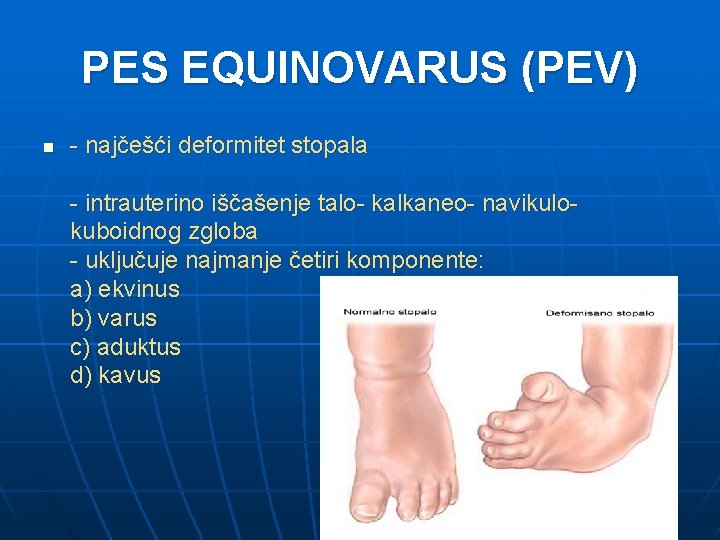 PES EQUINOVARUS (PEV) n - najčešći deformitet stopala - intrauterino iščašenje talo- kalkaneo- navikulokuboidnog
