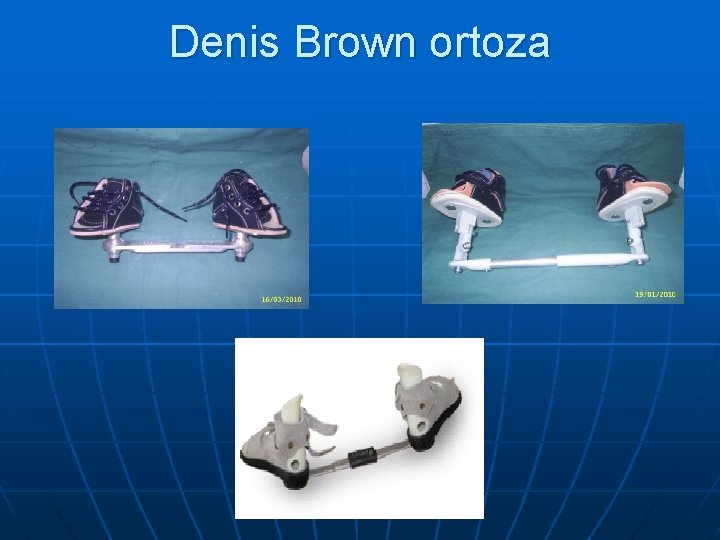 Denis Brown ortoza 