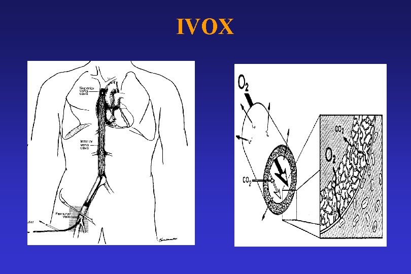 IVOX 