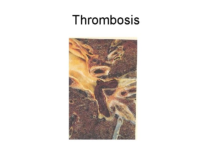 Thrombosis 