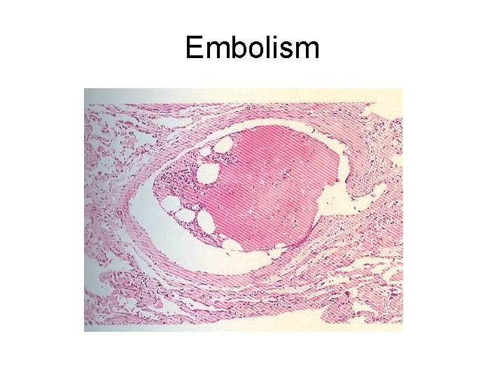 Embolism 