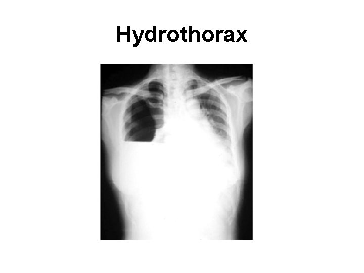 Hydrothorax 