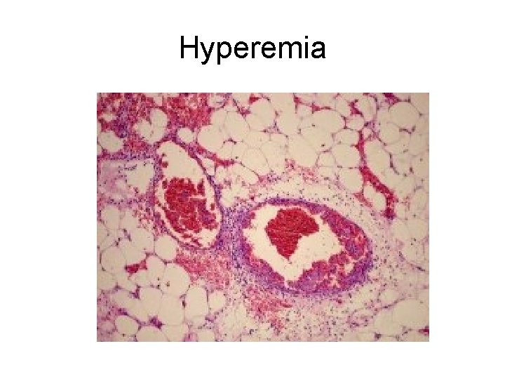 Hyperemia 