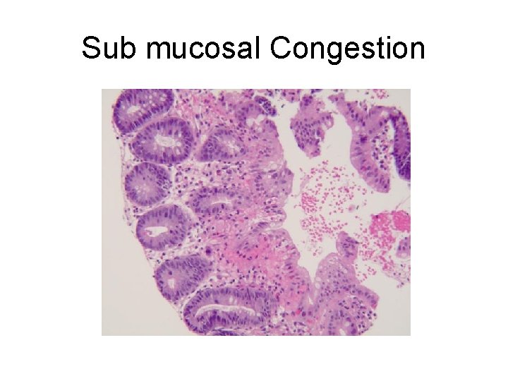 Sub mucosal Congestion 