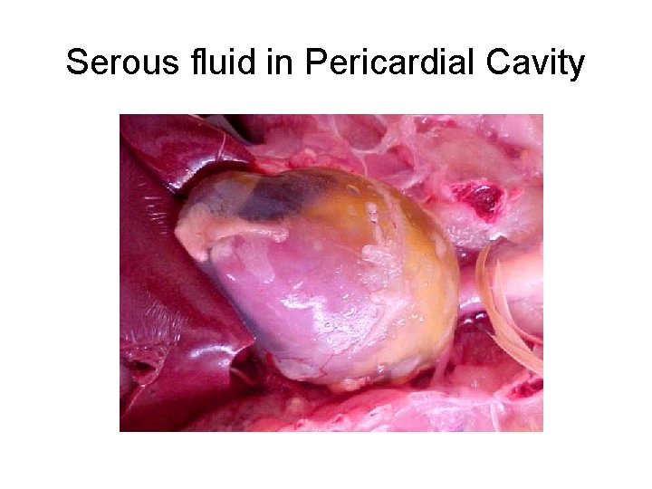 Serous fluid in Pericardial Cavity 