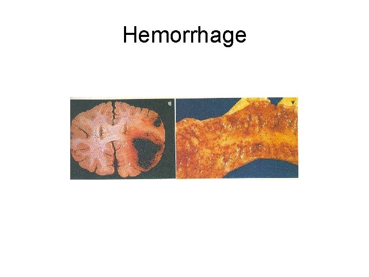 Hemorrhage 