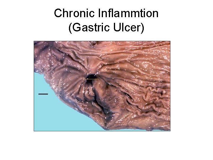 Chronic Inflammtion (Gastric Ulcer) 