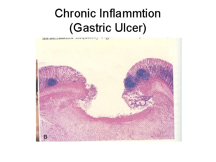 Chronic Inflammtion (Gastric Ulcer) 