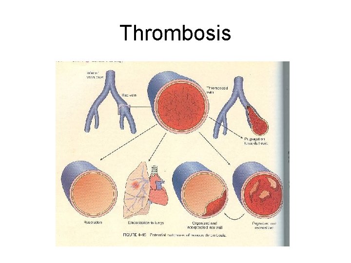 Thrombosis 
