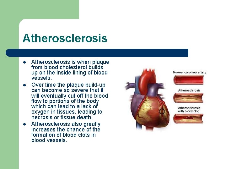 Atherosclerosis l l l Atherosclerosis is when plaque from blood cholesterol builds up on