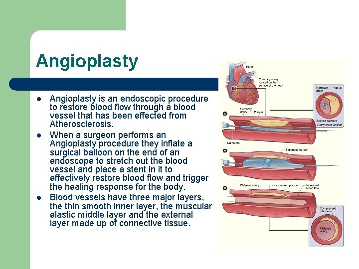 Angioplasty l l l Angioplasty is an endoscopic procedure to restore blood flow through