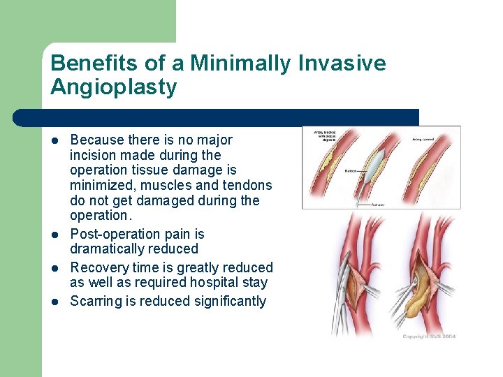 Benefits of a Minimally Invasive Angioplasty l l Because there is no major incision