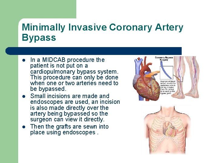 Minimally Invasive Coronary Artery Bypass l l l In a MIDCAB procedure the patient