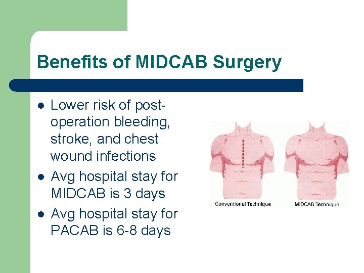 Benefits of MIDCAB Surgery l l l Lower risk of postoperation bleeding, stroke, and