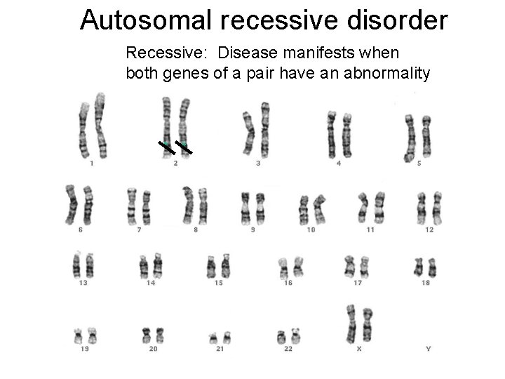 Autosomal recessive disorder Recessive: Disease manifests when both genes of a pair have an