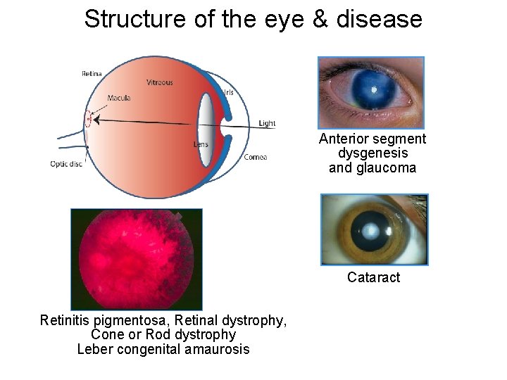 Structure of the eye & disease Anterior segment dysgenesis and glaucoma Cataract Retinitis pigmentosa,