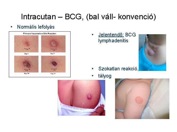 Intracutan – BCG, (bal váll- konvenció) • Normális lefolyás • Jelentendő: BCG lymphadenitis •