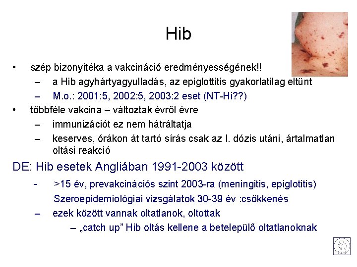 Hib • • szép bizonyítéka a vakcináció eredményességének!! – a Hib agyhártyagyulladás, az epiglottitis