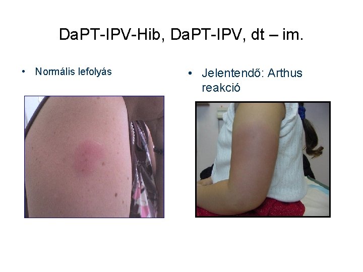 Da. PT-IPV-Hib, Da. PT-IPV, dt – im. • Normális lefolyás • Jelentendő: Arthus reakció