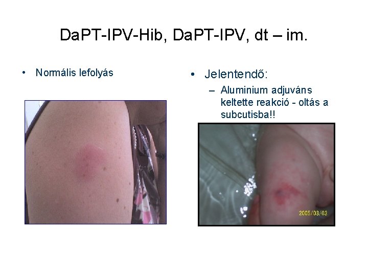 Da. PT-IPV-Hib, Da. PT-IPV, dt – im. • Normális lefolyás • Jelentendő: – Aluminium