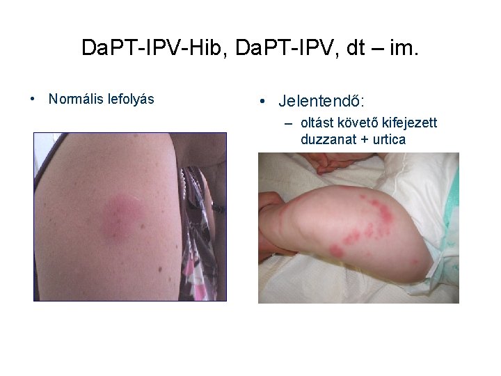 Da. PT-IPV-Hib, Da. PT-IPV, dt – im. • Normális lefolyás • Jelentendő: – oltást