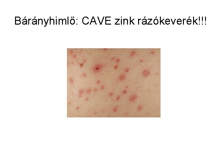 Bárányhimlő: CAVE zink rázókeverék!!! 