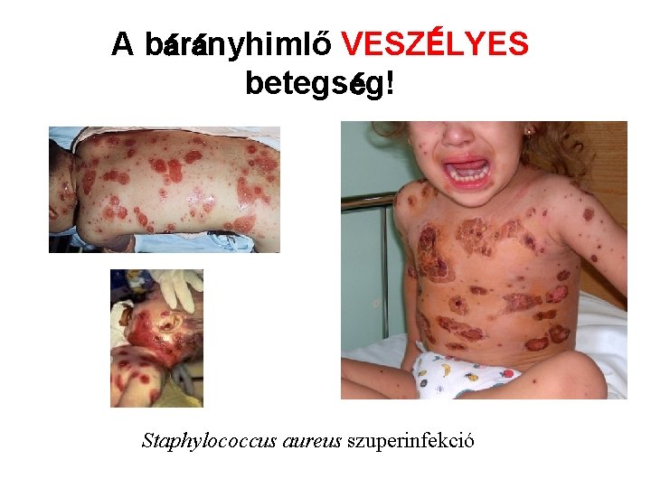 A bárányhimlő VESZÉLYES betegség! Staphylococcus aureus szuperinfekció 