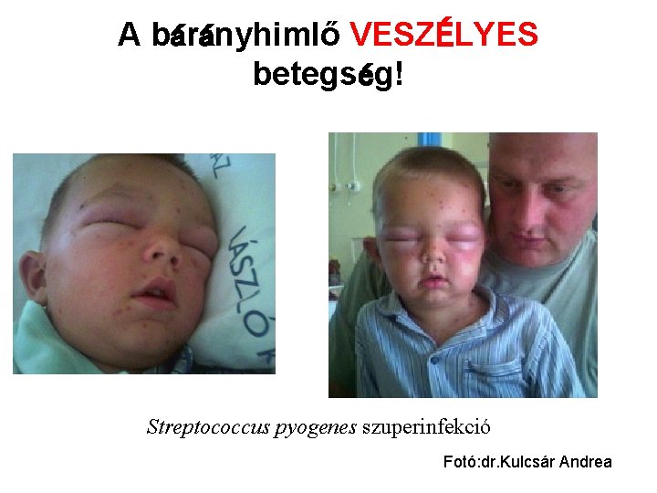 A bárányhimlő VESZÉLYES betegség! Streptococcus pyogenes szuperinfekció Fotó: dr. Kulcsár Andrea 