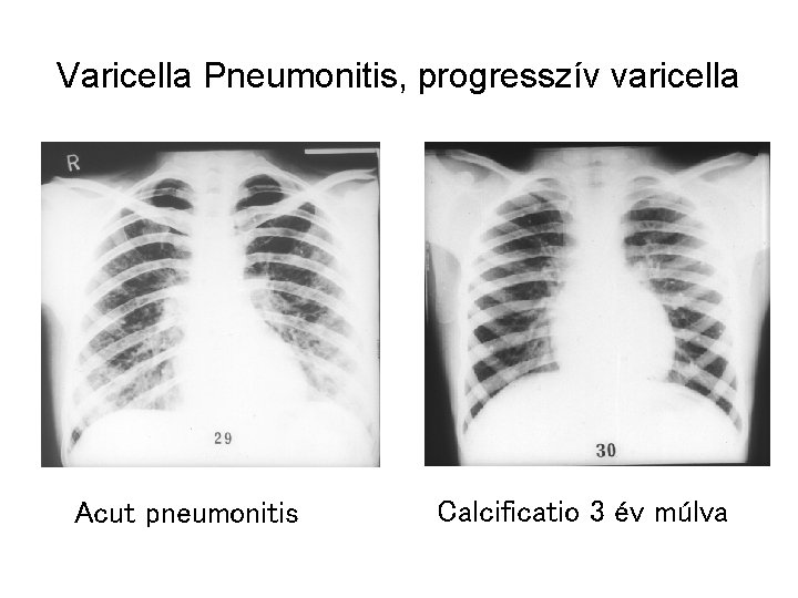 Varicella Pneumonitis, progresszív varicella Acut pneumonitis Calcificatio 3 év múlva 