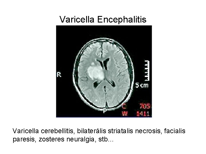 Varicella Encephalitis Varicella cerebellitis, bilaterális striatalis necrosis, facialis paresis, zosteres neuralgia, stb… 