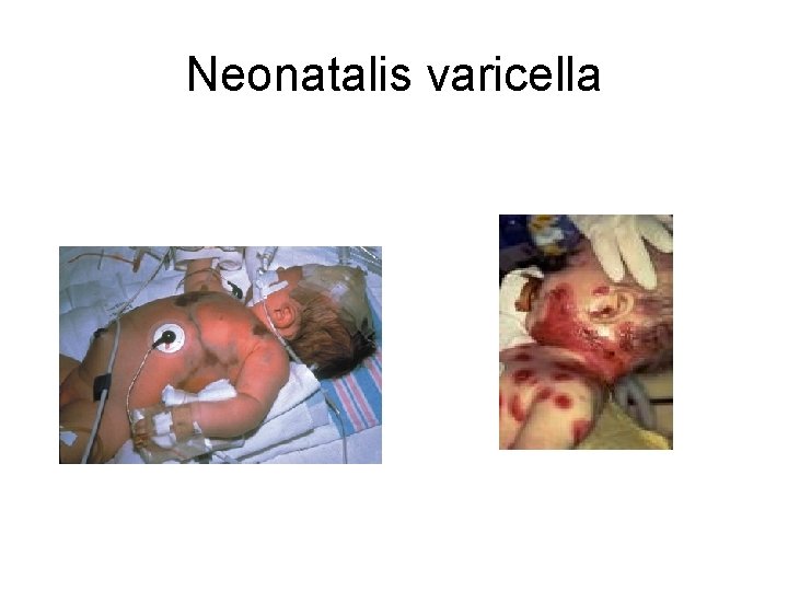 Neonatalis varicella 