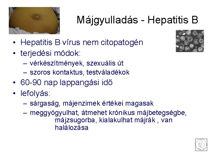 Májgyulladás - Hepatitis B • Hepatitis B vírus nem citopatogén • terjedési módok: –