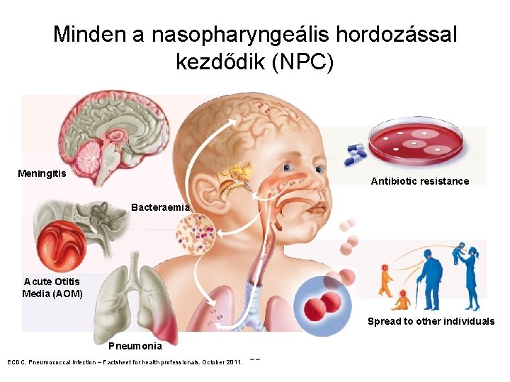 Minden a nasopharyngeális hordozással kezdődik (NPC) Meningitis Antibiotic resistance Bacteraemia Acute Otitis Media (AOM)