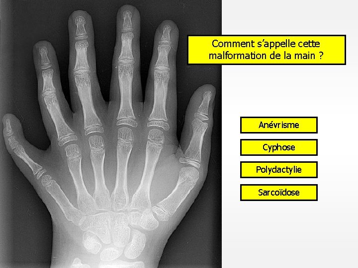 Comment s’appelle cette malformation de la main ? Anévrisme Cyphose Polydactylie Sarcoïdose 