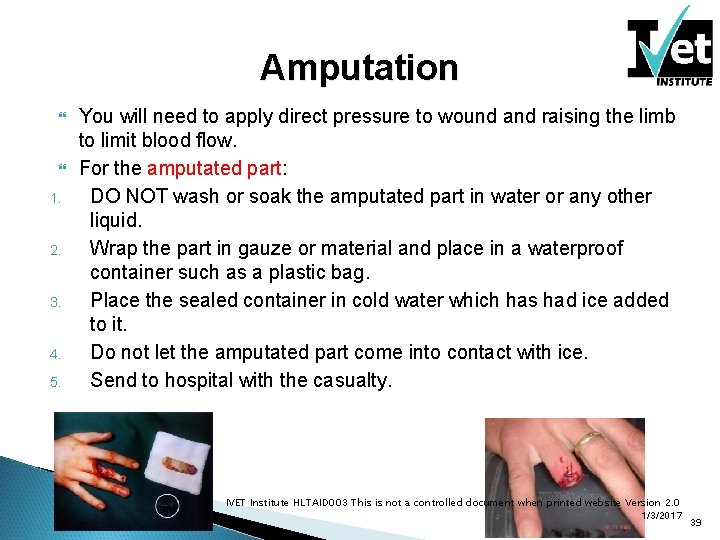 Amputation 1. 2. 3. 4. 5. You will need to apply direct pressure to