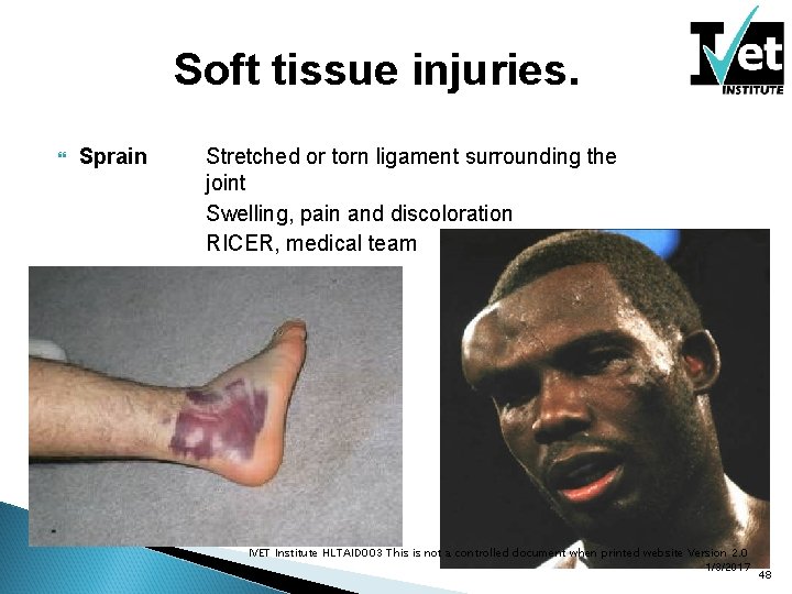 Soft tissue injuries. Sprain Stretched or torn ligament surrounding the joint Swelling, pain and